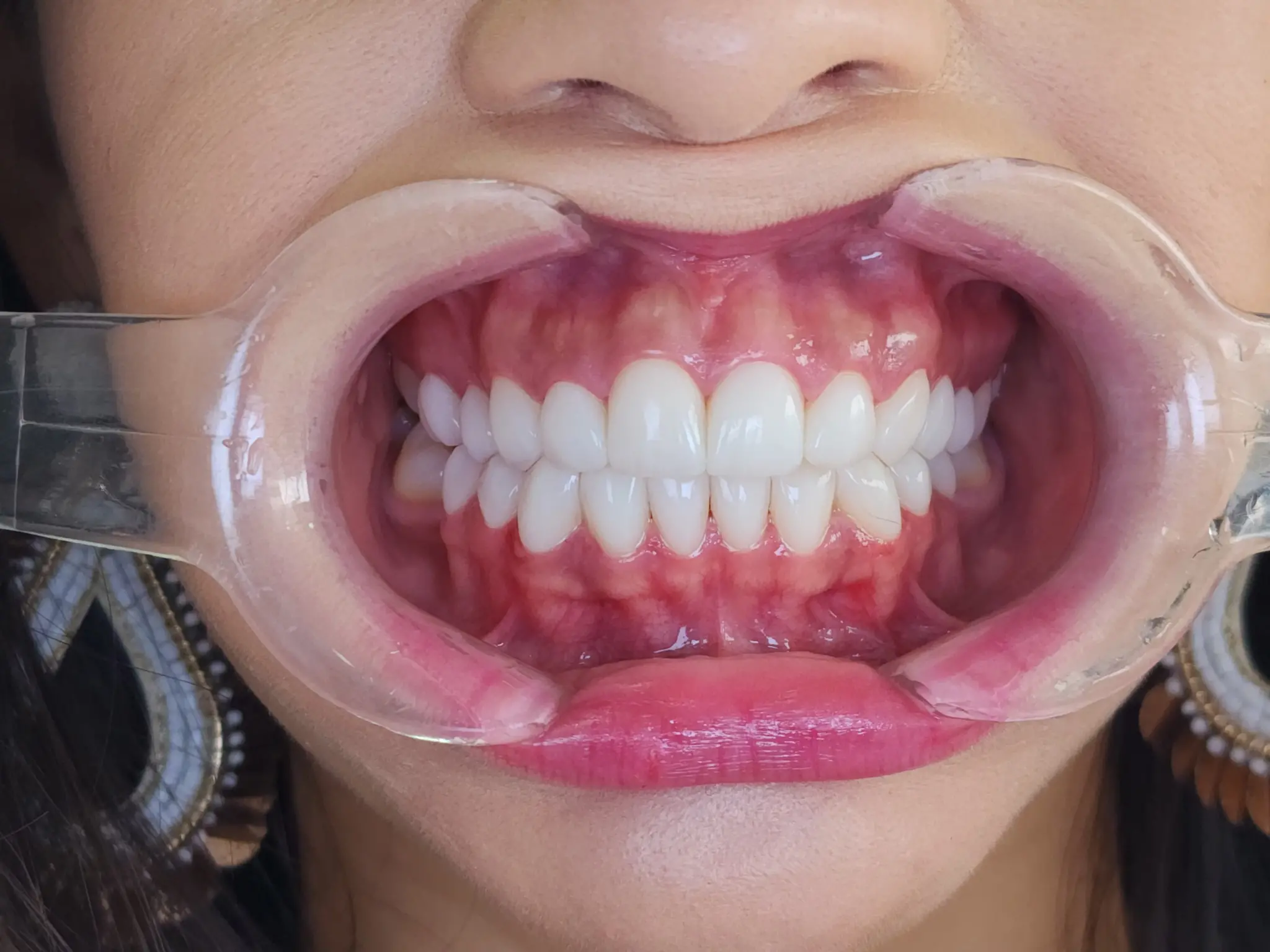 Tratamiento-dental-Manizales