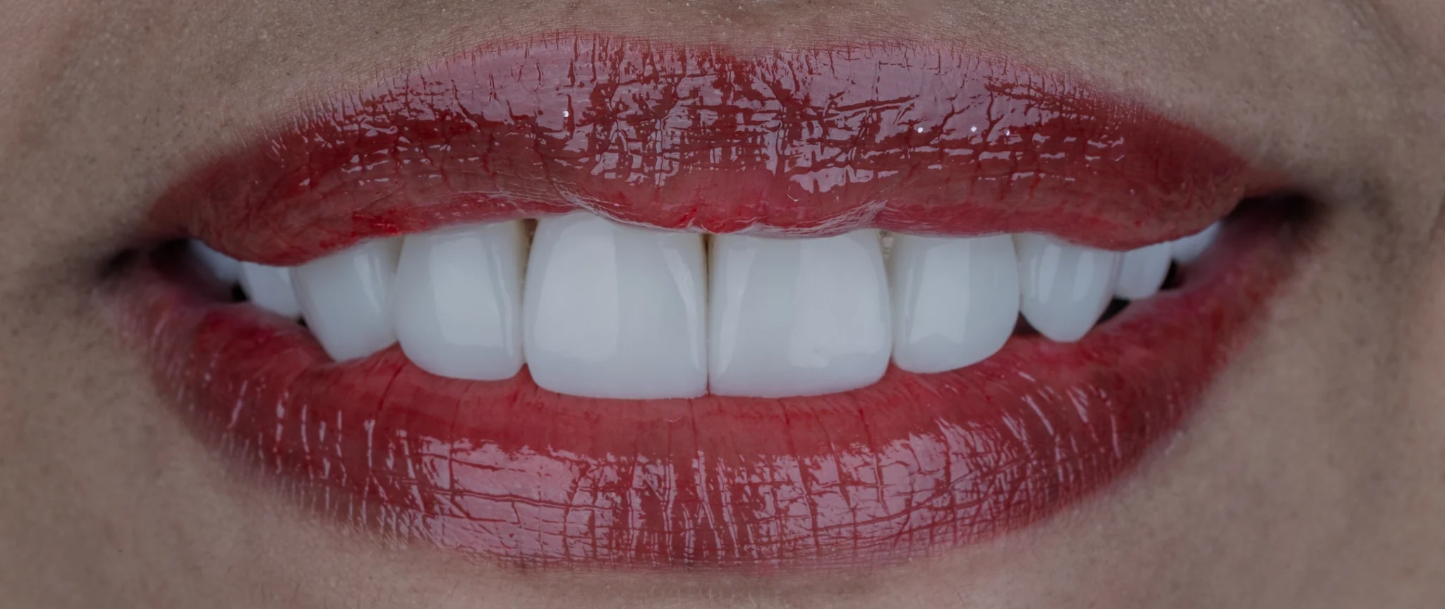 Microdiseño-de-sonrisa